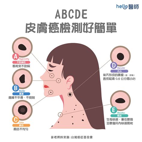 乳頭長痣|健康網》長痣＝皮膚癌？ 醫提7症狀：善用ABCDE原。